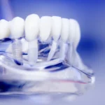 Implanty zębowe Szczecin cennik