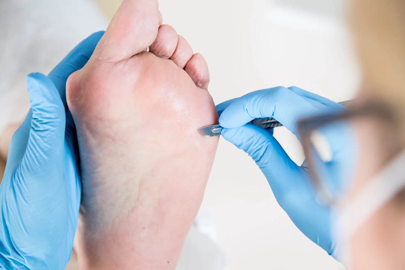 Co podolog robi z odciskami?